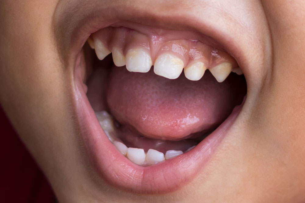 dental patient in need of frenectomy Dana Point CA