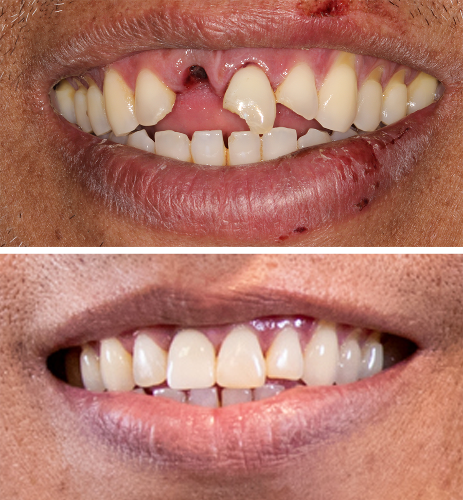 dereck dental implants before and after Dana Point CA