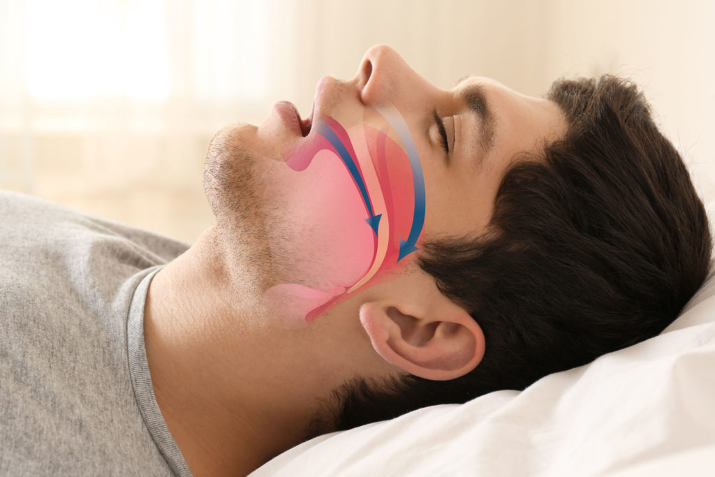 sleep apnea graphic Dana Point CA