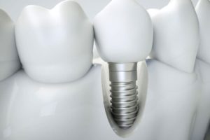 image of bone grafting for dental implants