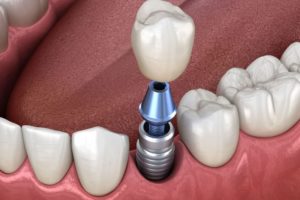 model of a dental implant, dana point ca