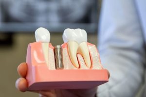 dental implants