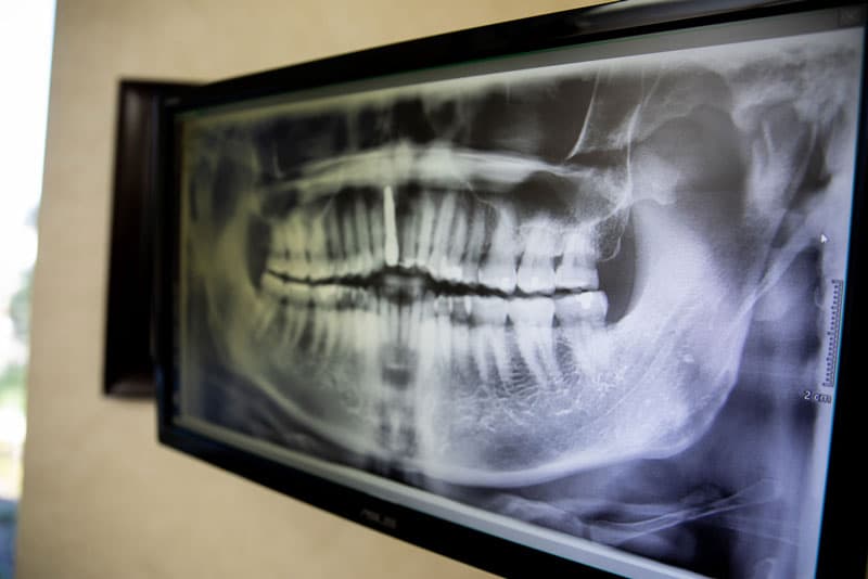 teeth-xray