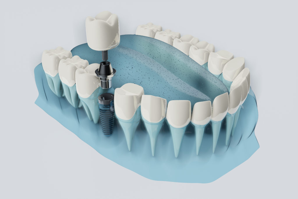 dental implants dana point ca