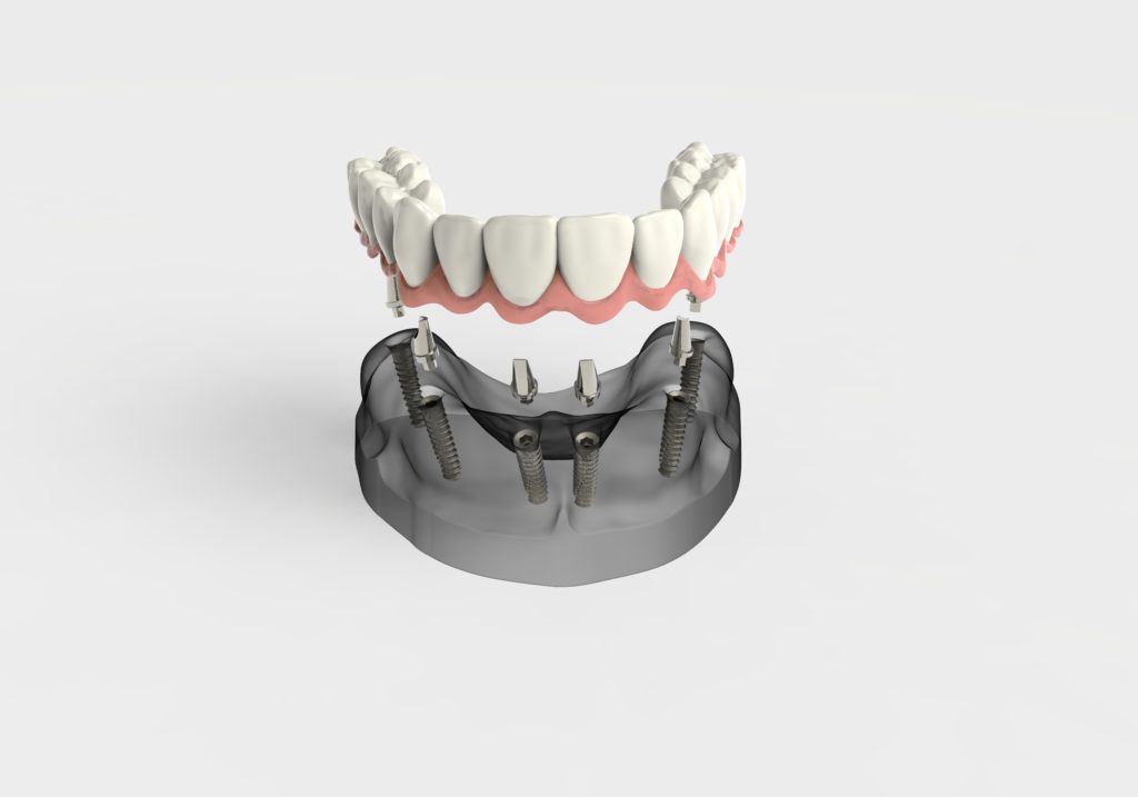 full arch dental implants dana point ca