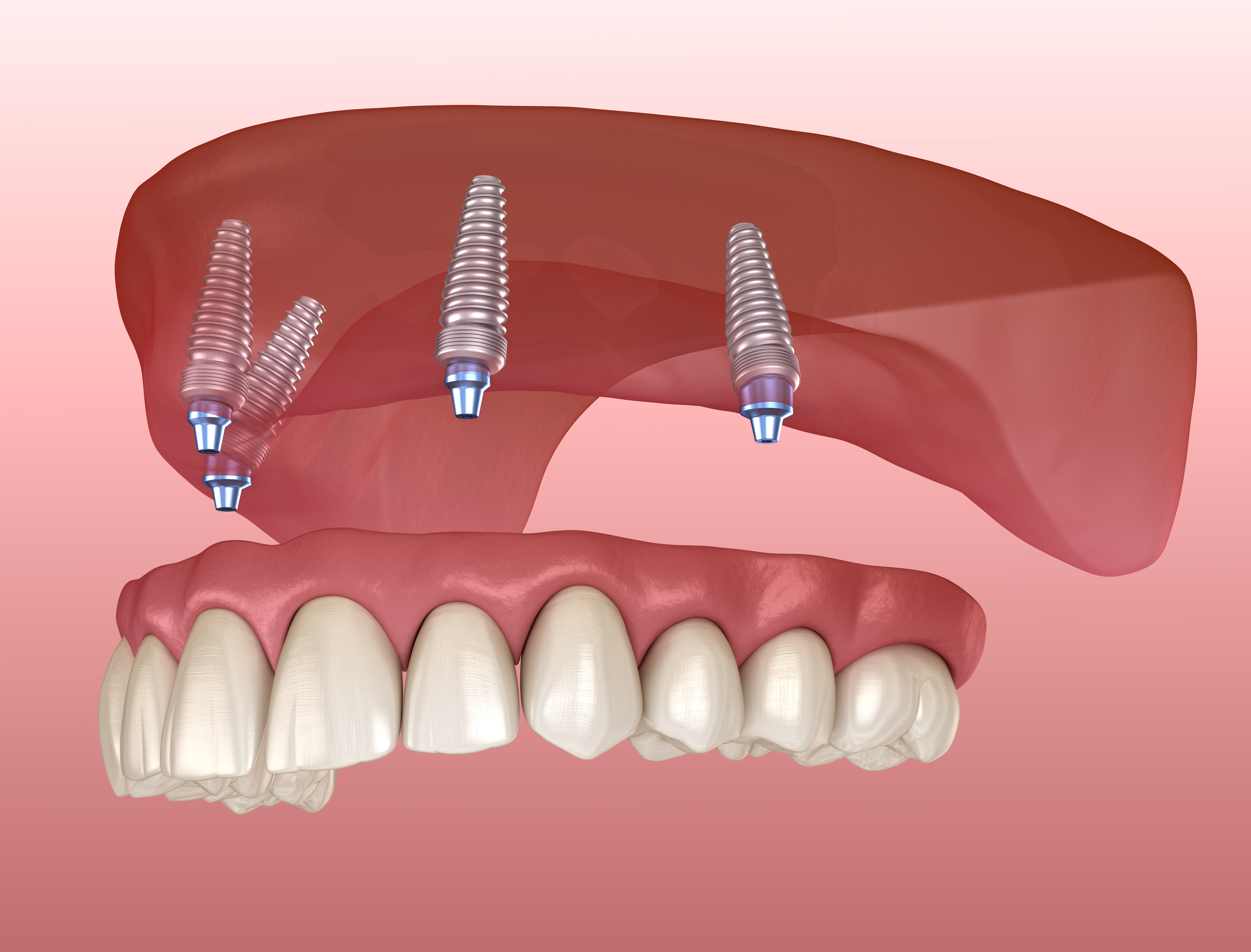 full mouth implant